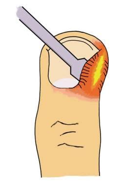 Paronychia Treatment Management Approach Considerations