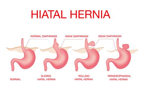 Picture Of Hiatal Hernia