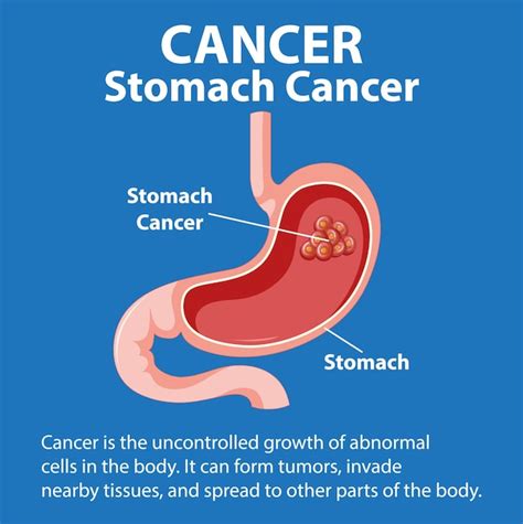 Premium Vector Illustrated Infographic Of Stomach Cancer Growth