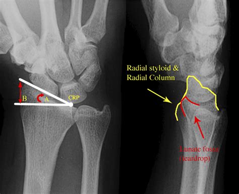 Radius Styloid Process Fracture