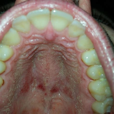 Rash On Roof Of Mouth Any Advice Appreciated R Dentistry