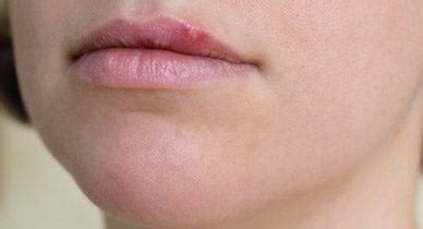 Red Bumps Spots On Lips Turned Into Rash Starting From The Inner Border