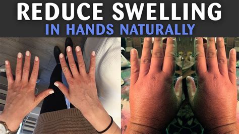 Reduce Swelling In Hands How To Reduce Swelling Naturally How To Treat