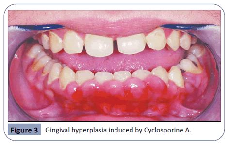 Review Differential Diagnosis Of Drug Induced Gingival Hyperplasia And