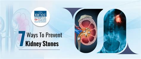 Seven Ways To Prevent Kidney Stones Dr Sandeep Nunia