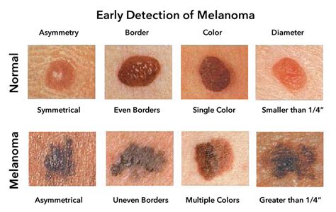 Skin Cancer In Black People Are They Really Less At Risk