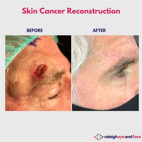 Skin Cancer Reconstruction Raleigh Eye And Face