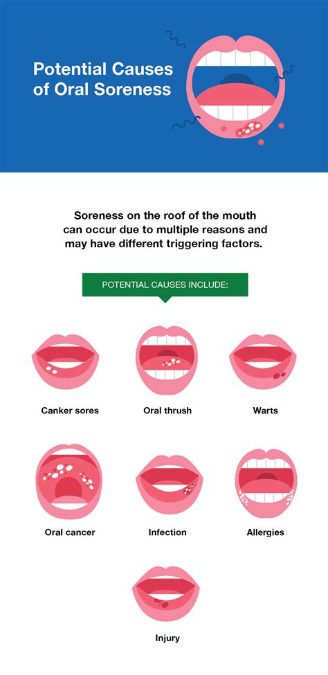 Sore Roof Of Mouth Causes Treatment Smartmouth