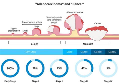 Stages Of Colon Polyps