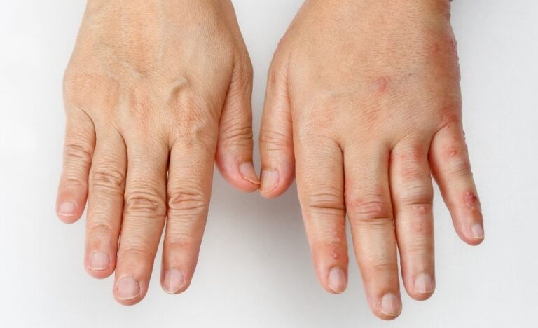 Suffer From Swollen Hands When Exercising Here S Why