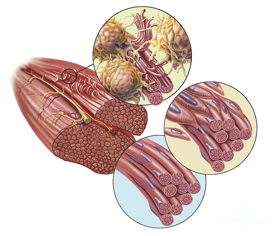 Torn Muscle Fibers With Healing Stages Digital Art By Trifocal