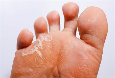 Untreated Athlete's Foot Fungus