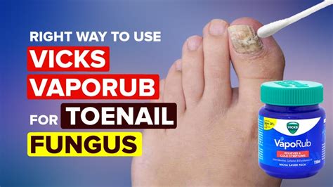 Vick S Vaporub For Nail Fungus Toe Fungus Journey Youtube