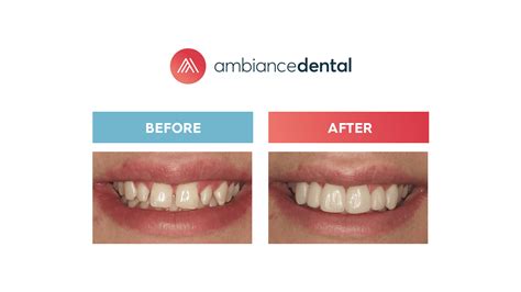 What Are The Elements Of The Perfect Smile Ambiance Dental