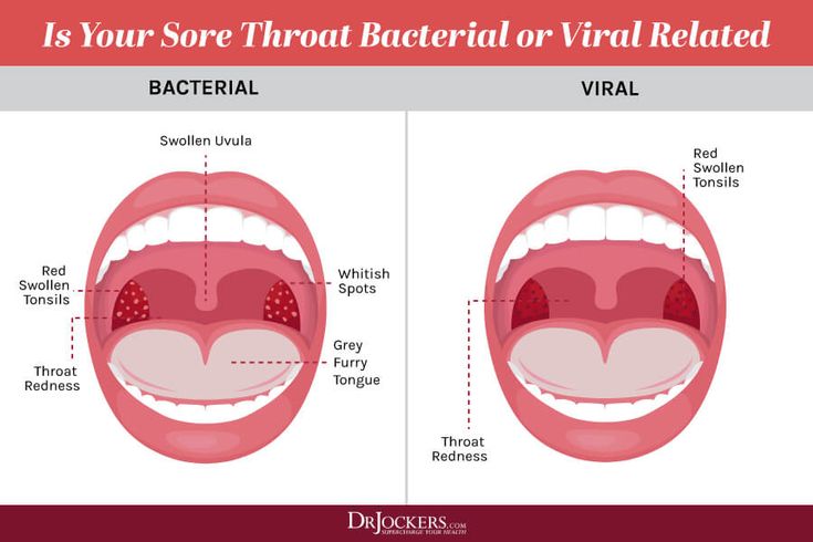 What Causes Sore Throat Jennifer Campbell