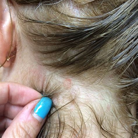 What Does Scalp Ringworm Look Like