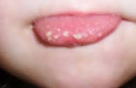 White Bump On Tongue Cancer